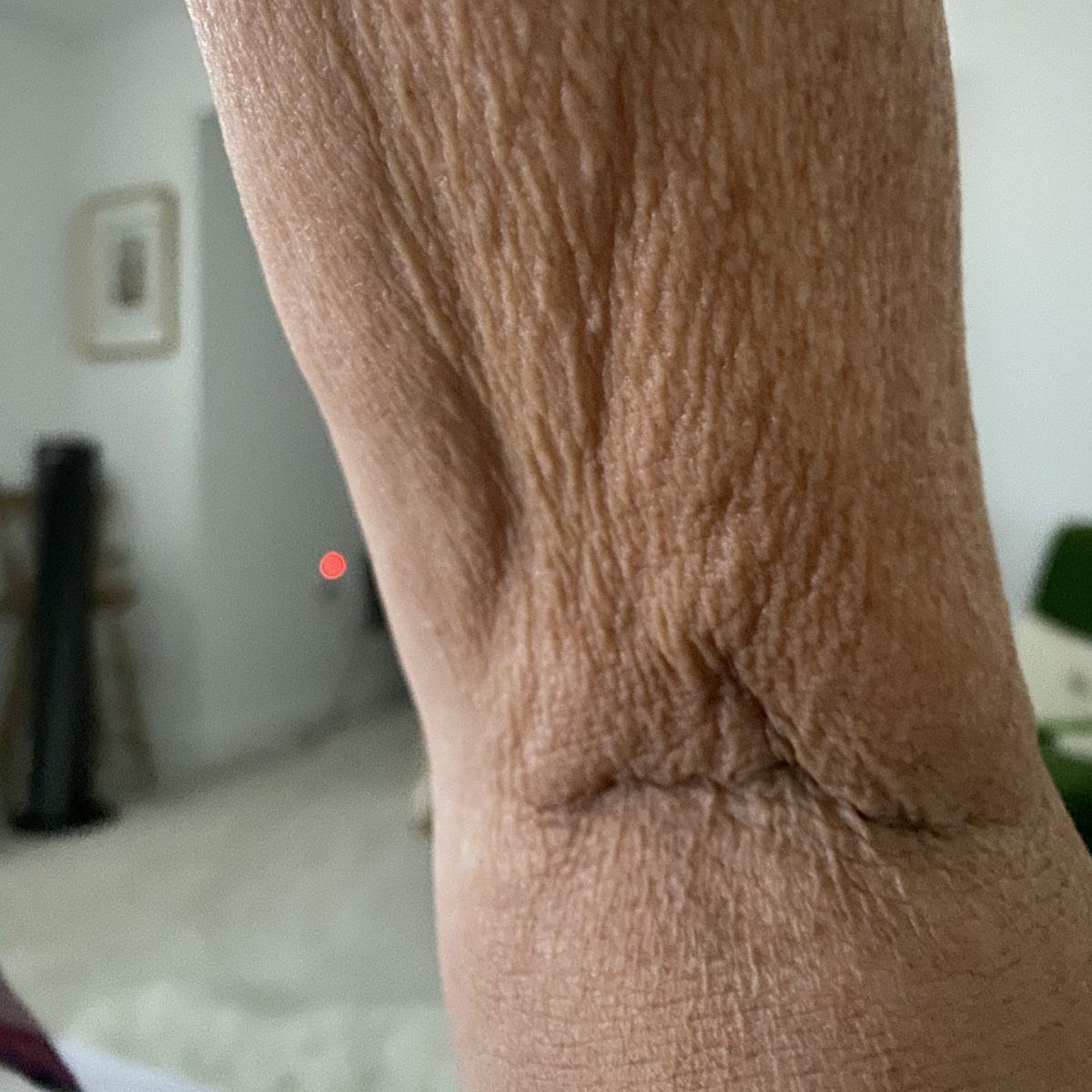 Inside elbow sagging skin